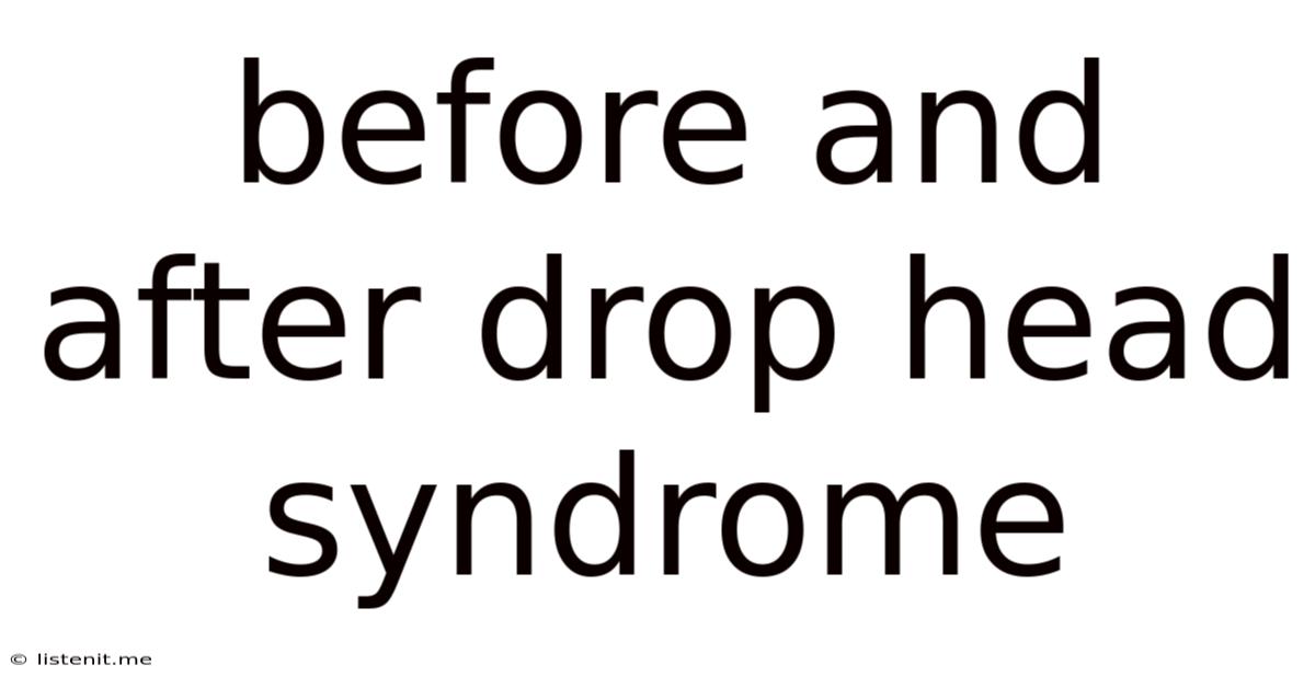 Before And After Drop Head Syndrome