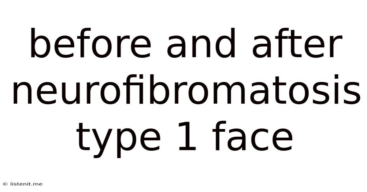 Before And After Neurofibromatosis Type 1 Face