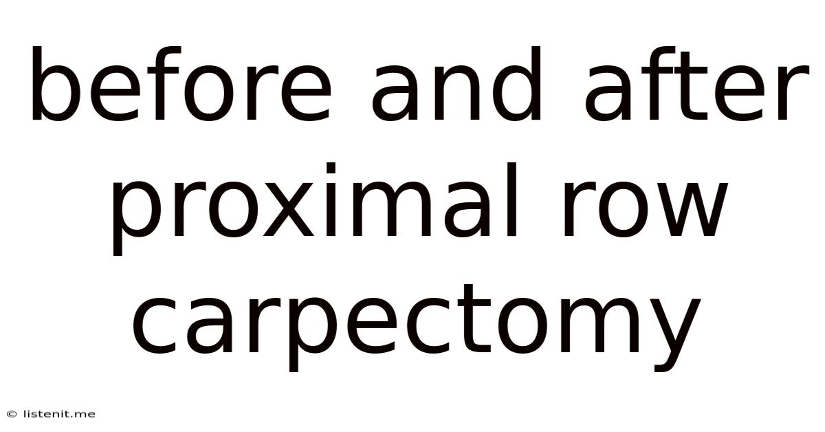 Before And After Proximal Row Carpectomy