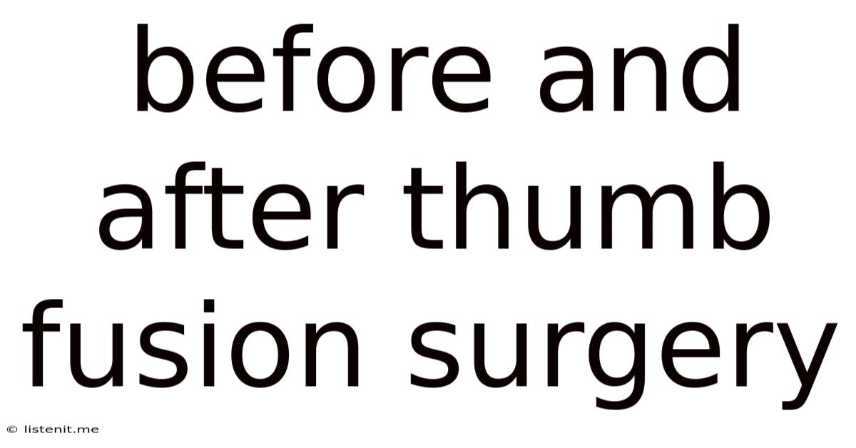 Before And After Thumb Fusion Surgery