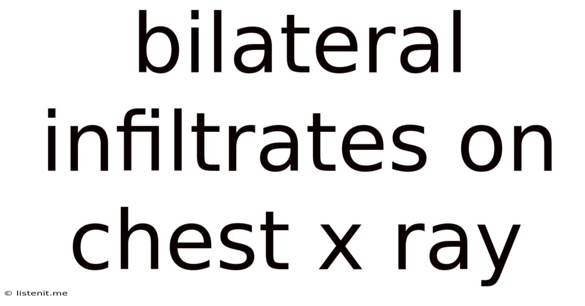 Bilateral Infiltrates On Chest X Ray