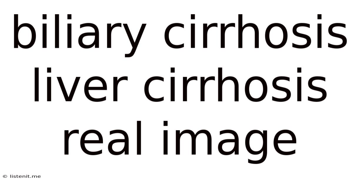 Biliary Cirrhosis Liver Cirrhosis Real Image