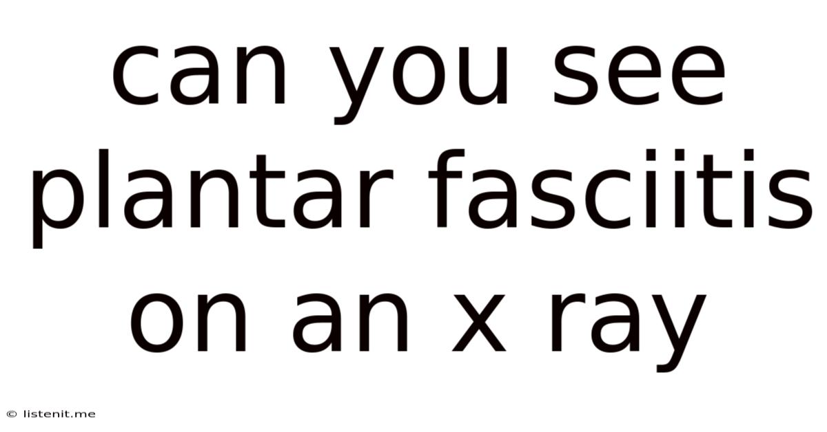 Can You See Plantar Fasciitis On An X Ray