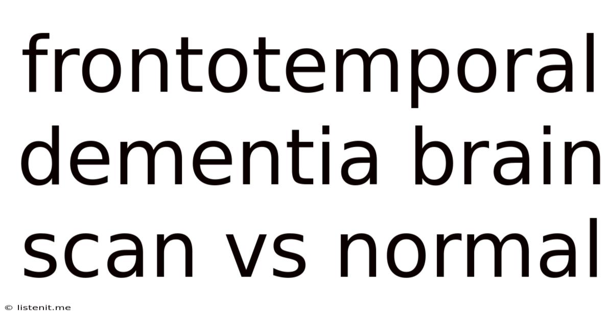 Frontotemporal Dementia Brain Scan Vs Normal