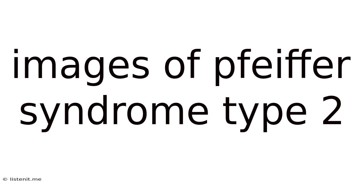 Images Of Pfeiffer Syndrome Type 2
