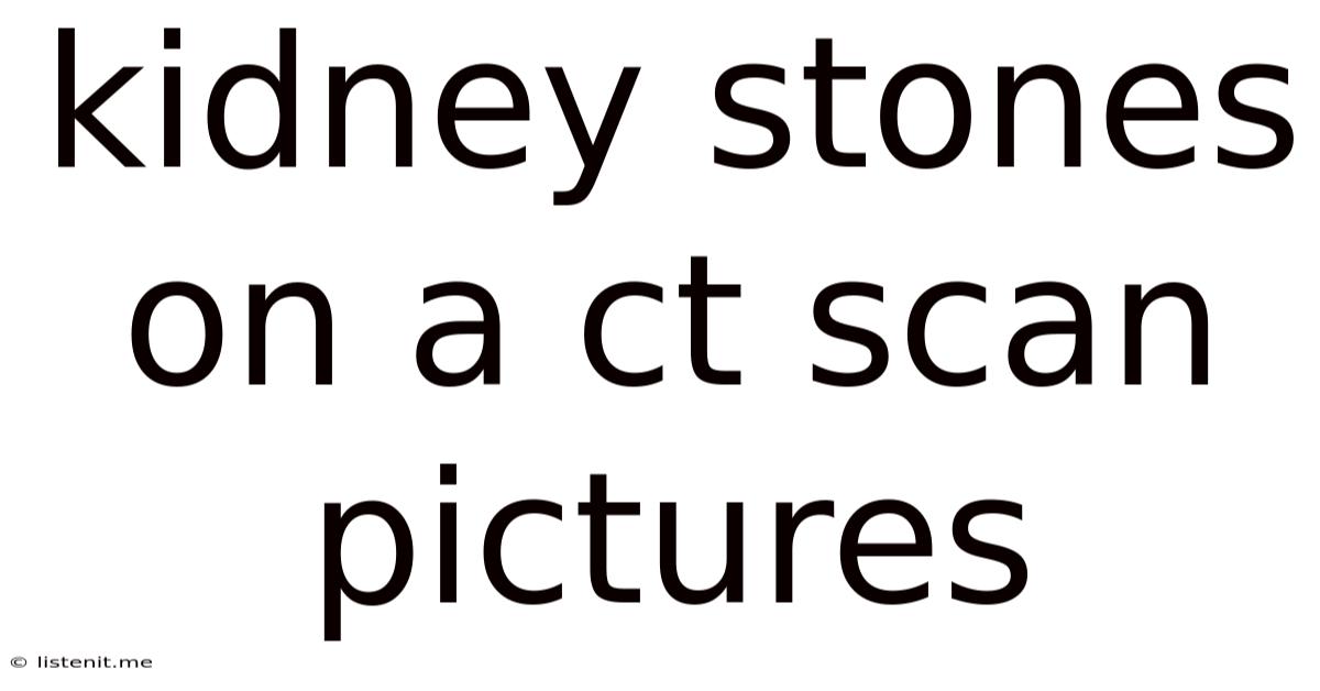Kidney Stones On A Ct Scan Pictures