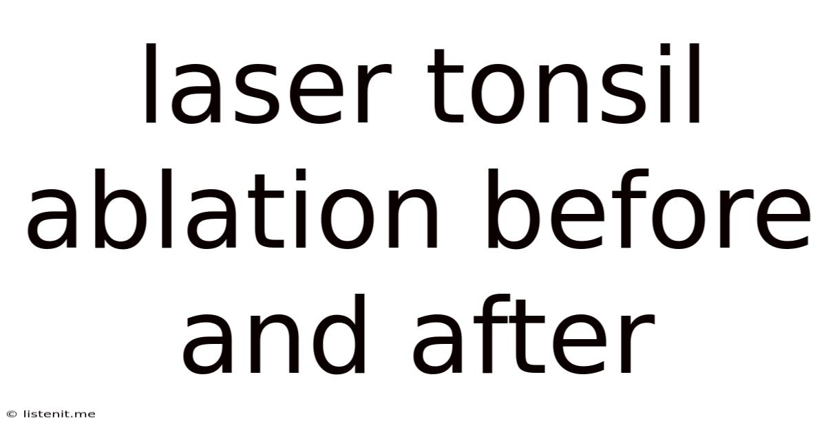 Laser Tonsil Ablation Before And After