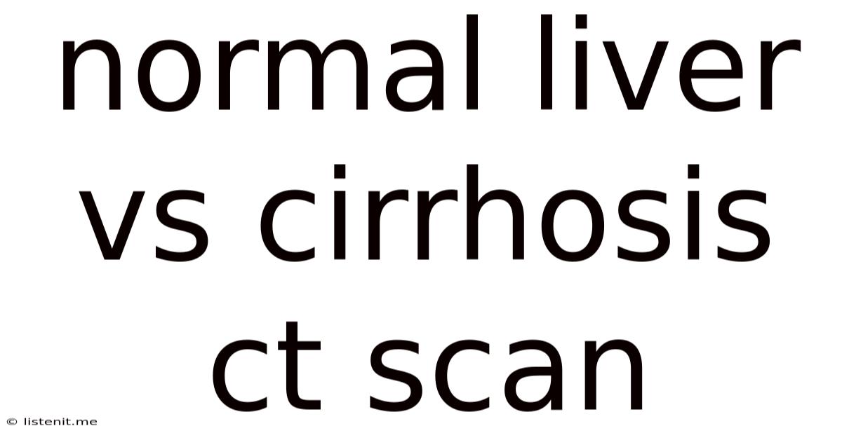 Normal Liver Vs Cirrhosis Ct Scan