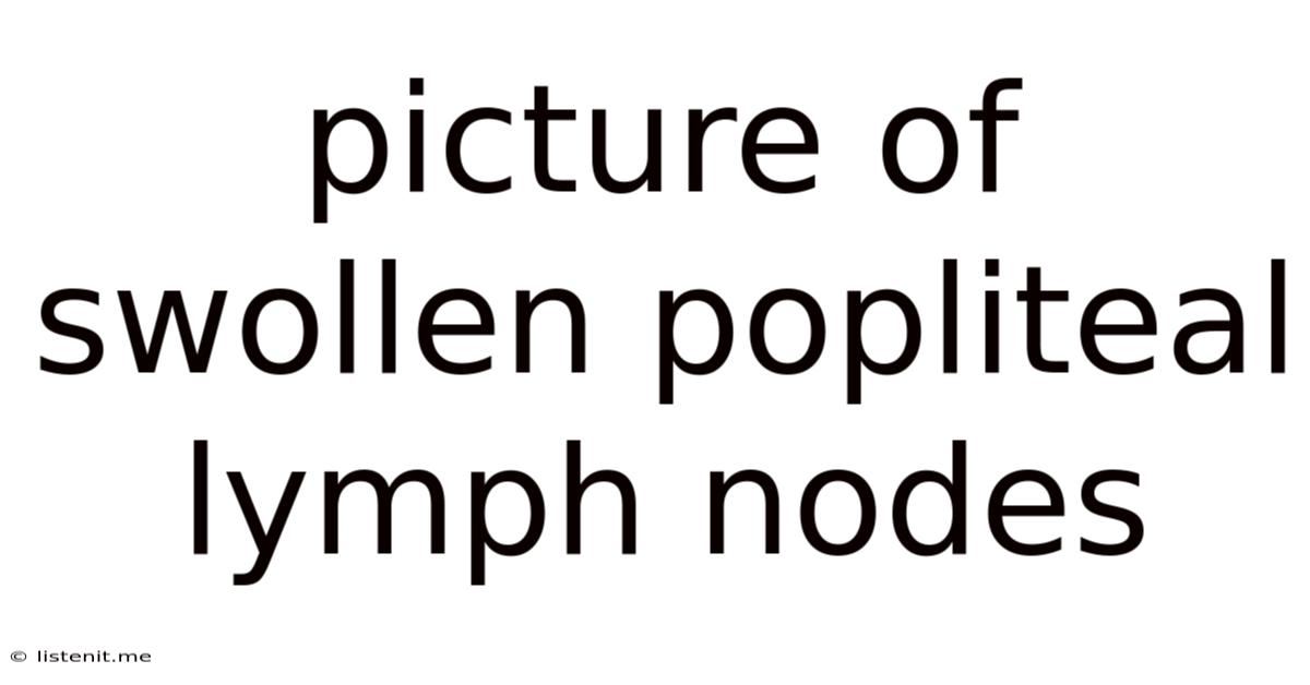 Picture Of Swollen Popliteal Lymph Nodes