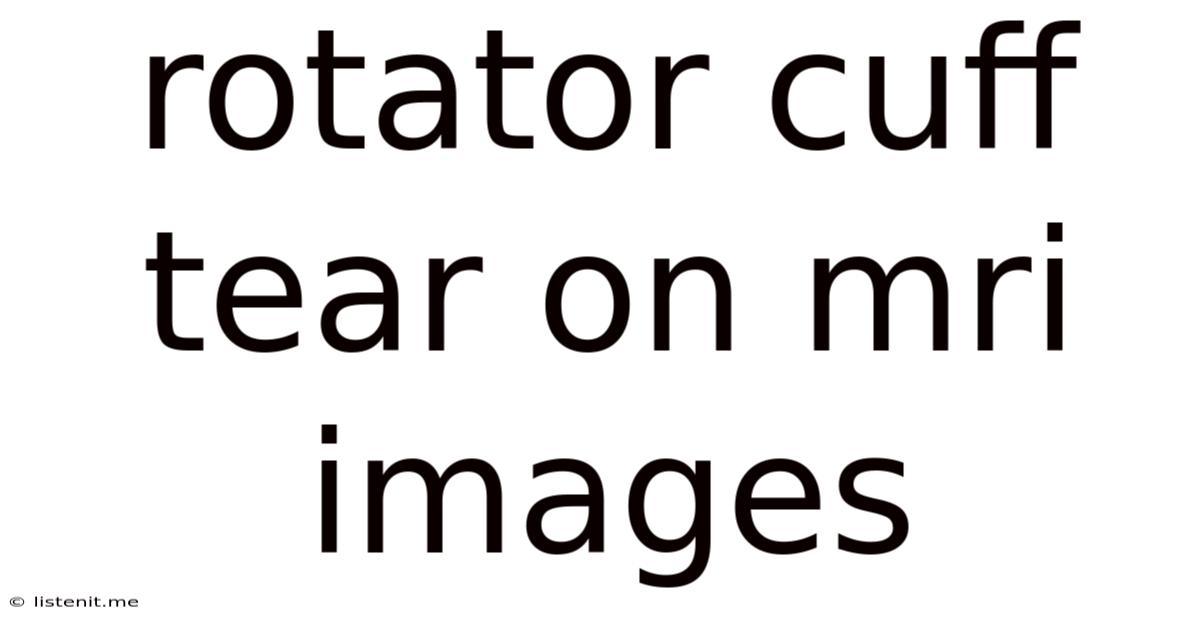 Rotator Cuff Tear On Mri Images